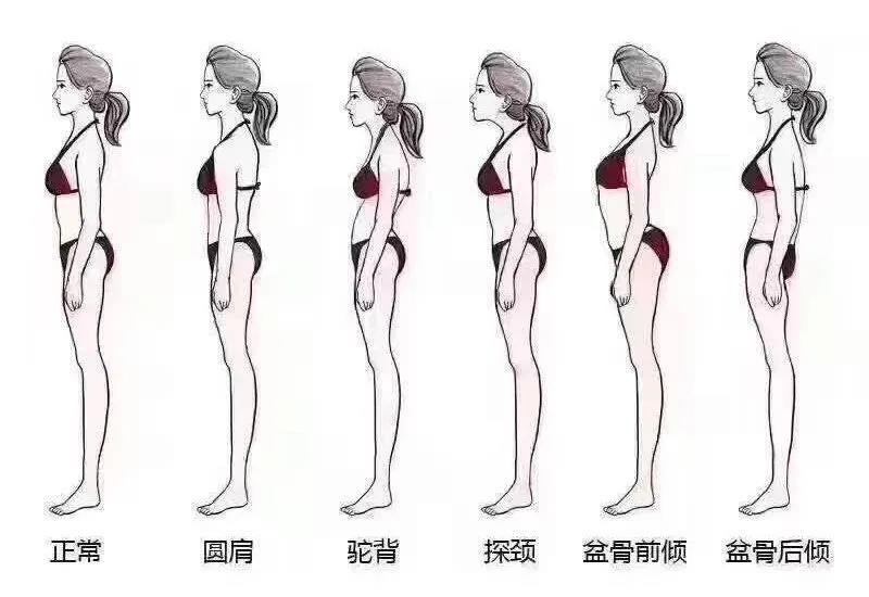 这些常见的不良体态你中招了吗